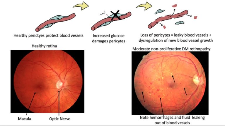 Eye Test Cost For Diabetes